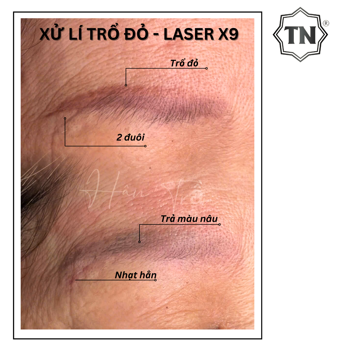 laser x9 1